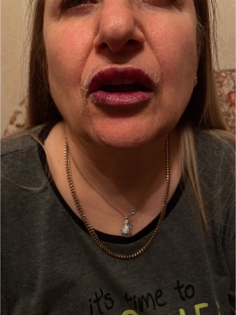 Фото 2. Почему случилось такое с губами? Это не некроз?