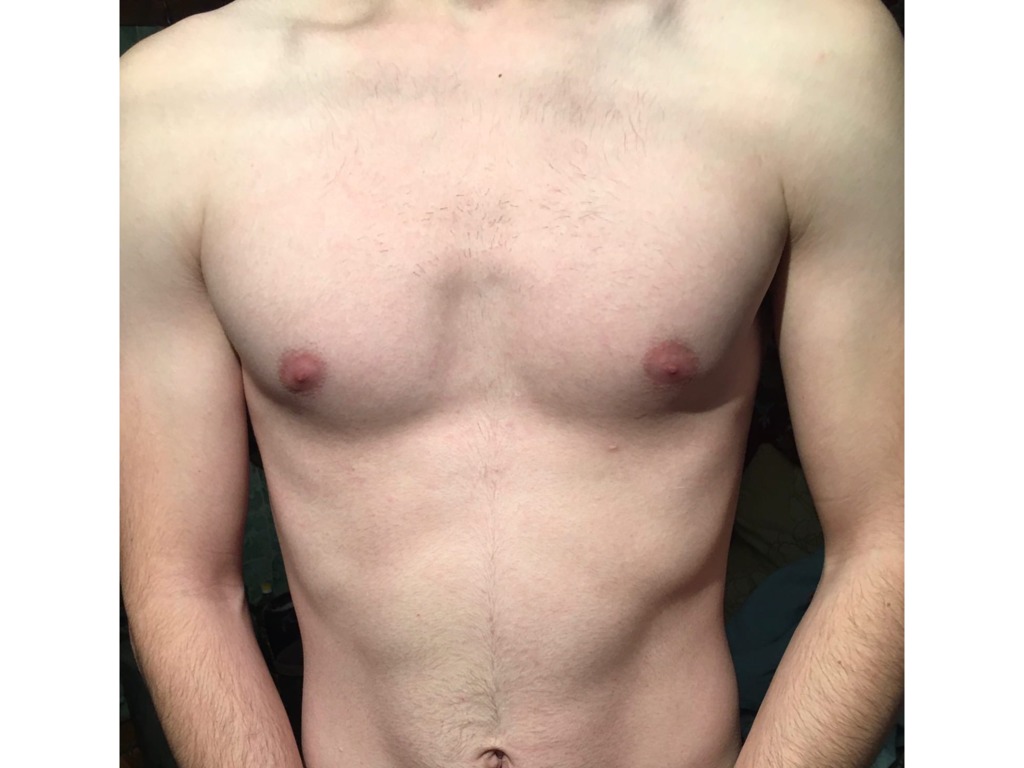 Фото 1. Как уменьшить промежуток между грудью?