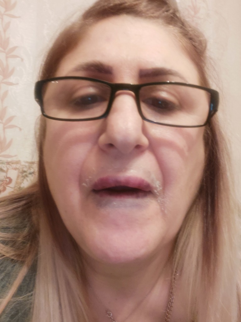 Фото 4. Почему случилось такое с губами? Это не некроз?