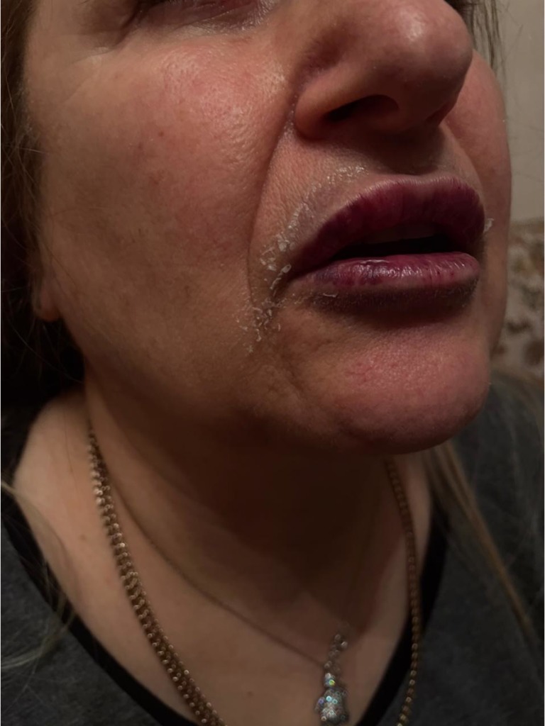 Фото 1. Почему случилось такое с губами? Это не некроз?