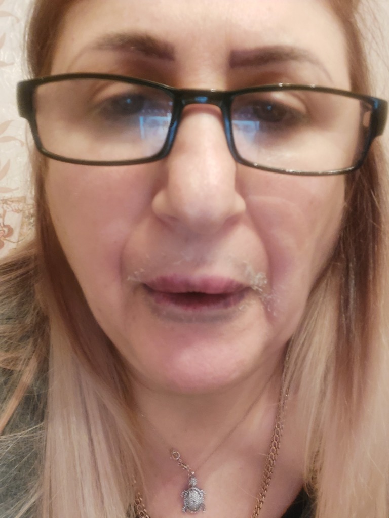 Фото 3. Почему случилось такое с губами? Это не некроз?