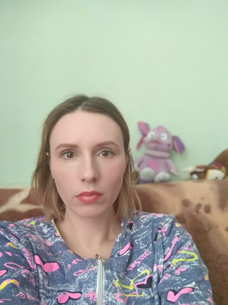 Фото 2. Как исправить ассиметрию после коррекции скул?