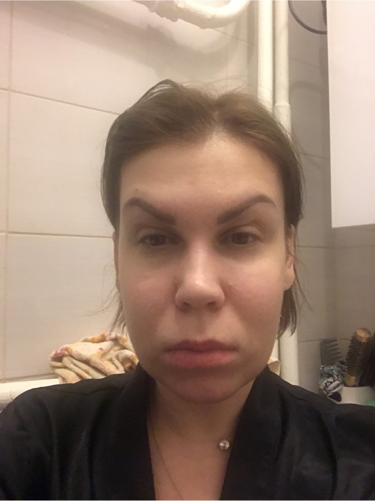 Фото 1. Может ли быть отечность после Радиесса?
