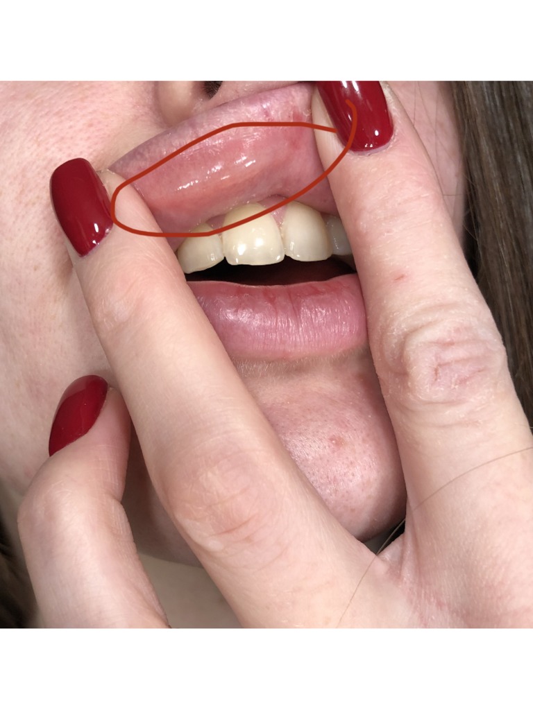 Фото 1. Остался ли филлер в губе спустя 3 года или это сросшиеся ткани?