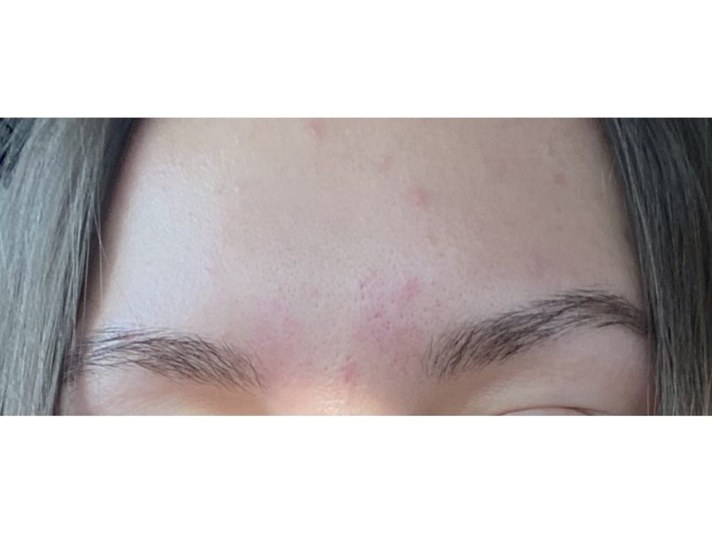 Фото 1. Как сгладить межбровную морщину?