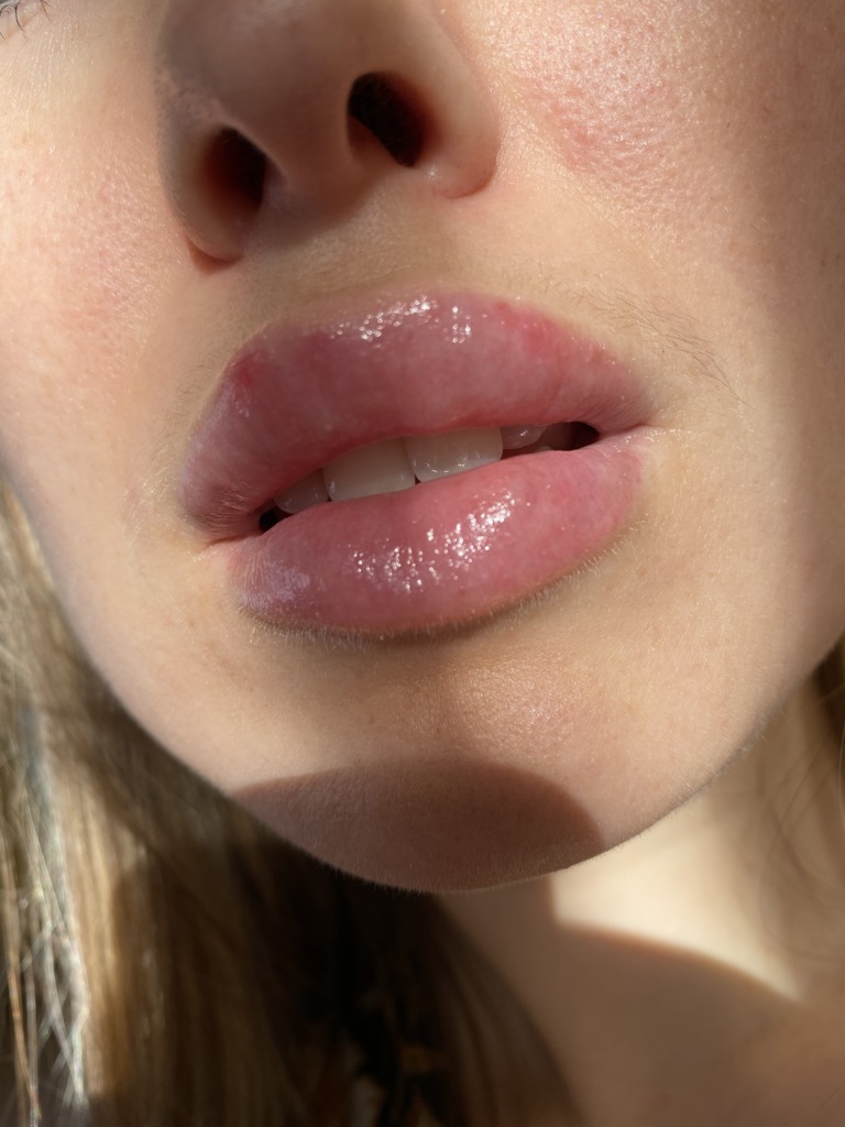 Фото 2. У меня фиброз?