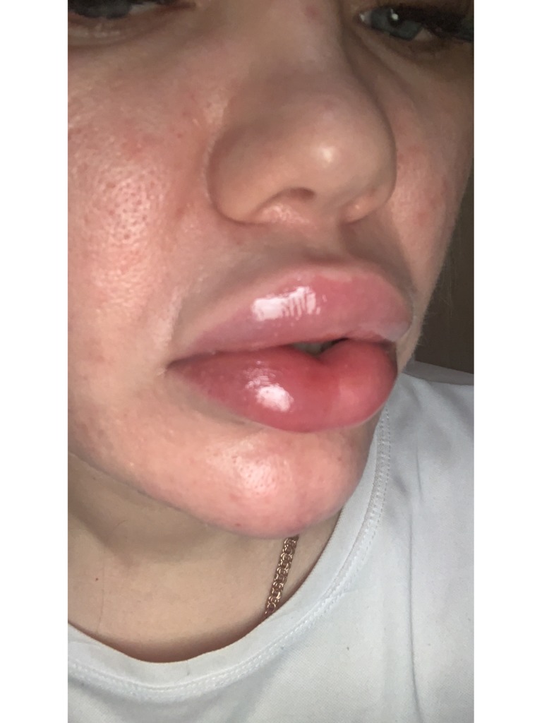 Фото 1. Что делать, когда раздуло губы и болит подбородок?