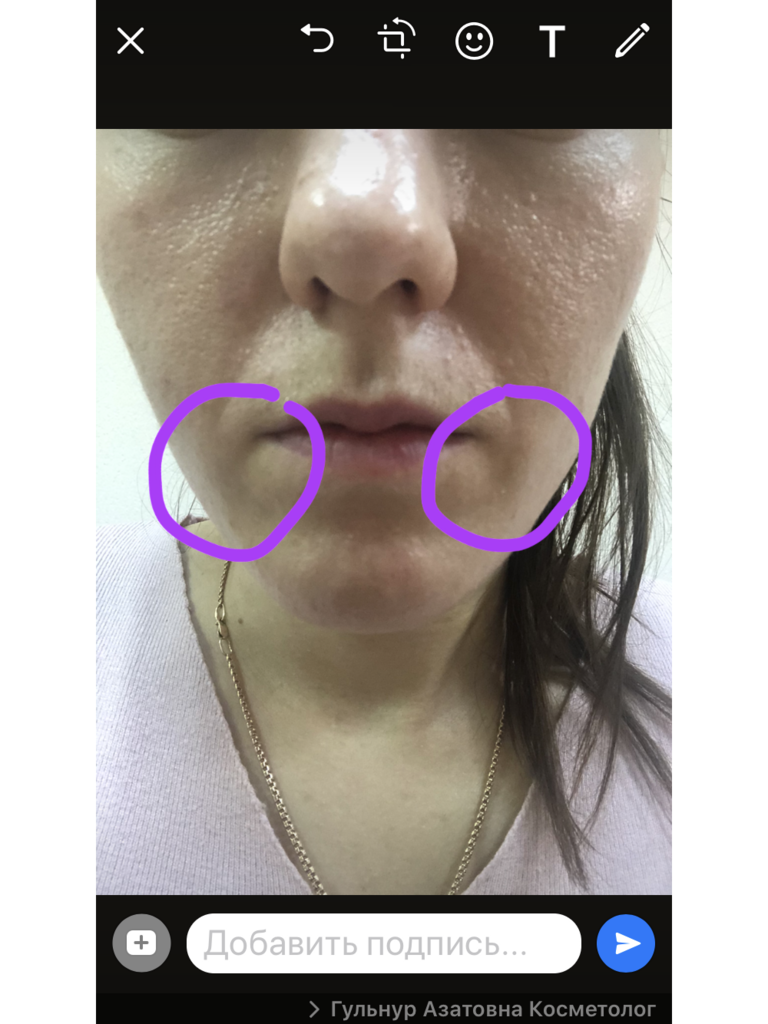 Фото 1. Пройдет ли уплотнение после филлера Dermalax?