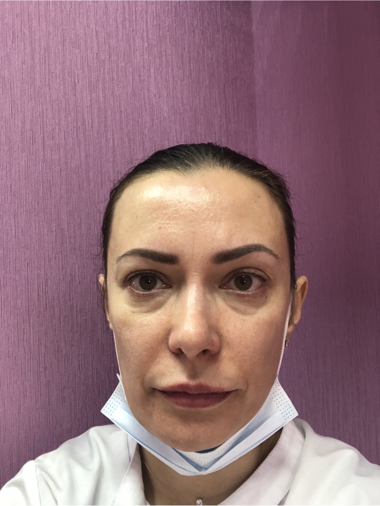 Фото 1. Возможна ли блефаропластика после липофилинга век?