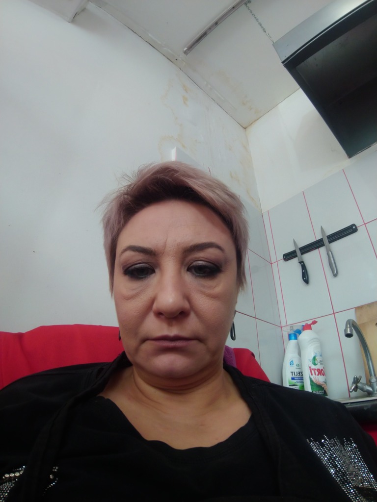 Фото 1. Как убрать мешки после филлера, введенного в носослезную борозду?