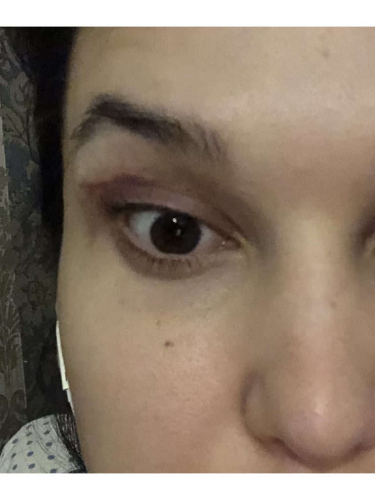 Фото 2. Как вернуть мимику после блефаропластики?