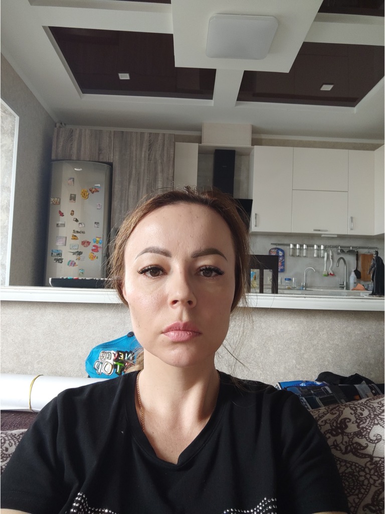 Фото 2. Можно ли убрать филлер на основе полимолочной кислоты и как?