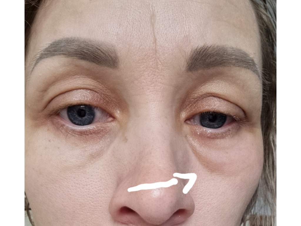 Фото 1. Как избавиться от отека после ботулотоксина?
