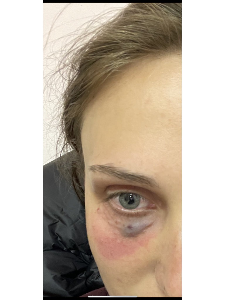 Фото 2. Подскажите, пожалуйста, такая опухлость под глазом это нормально?