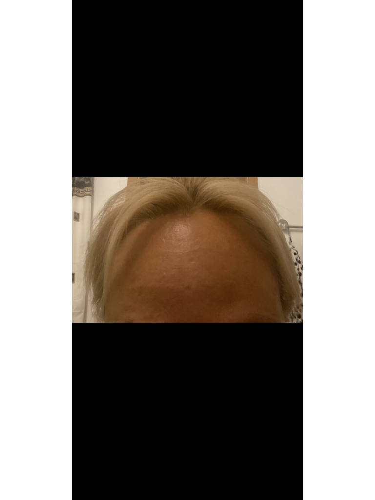 Фото 1. Поможет ли плазмолифтинг рассосать гель?