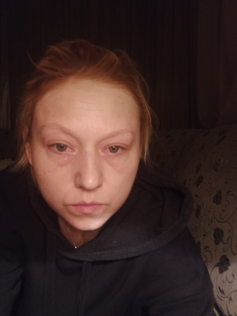 Фото 2. Избавит ли блефаропластика от отеков век?