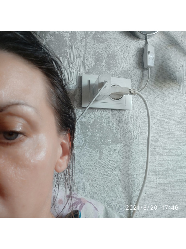 Фото 1. Должно ли так быть после введения филлера?