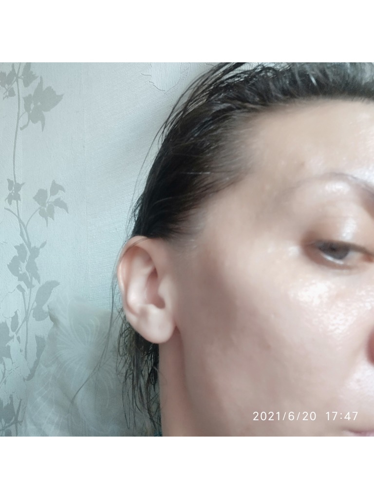 Фото 2. Должно ли так быть после введения филлера?