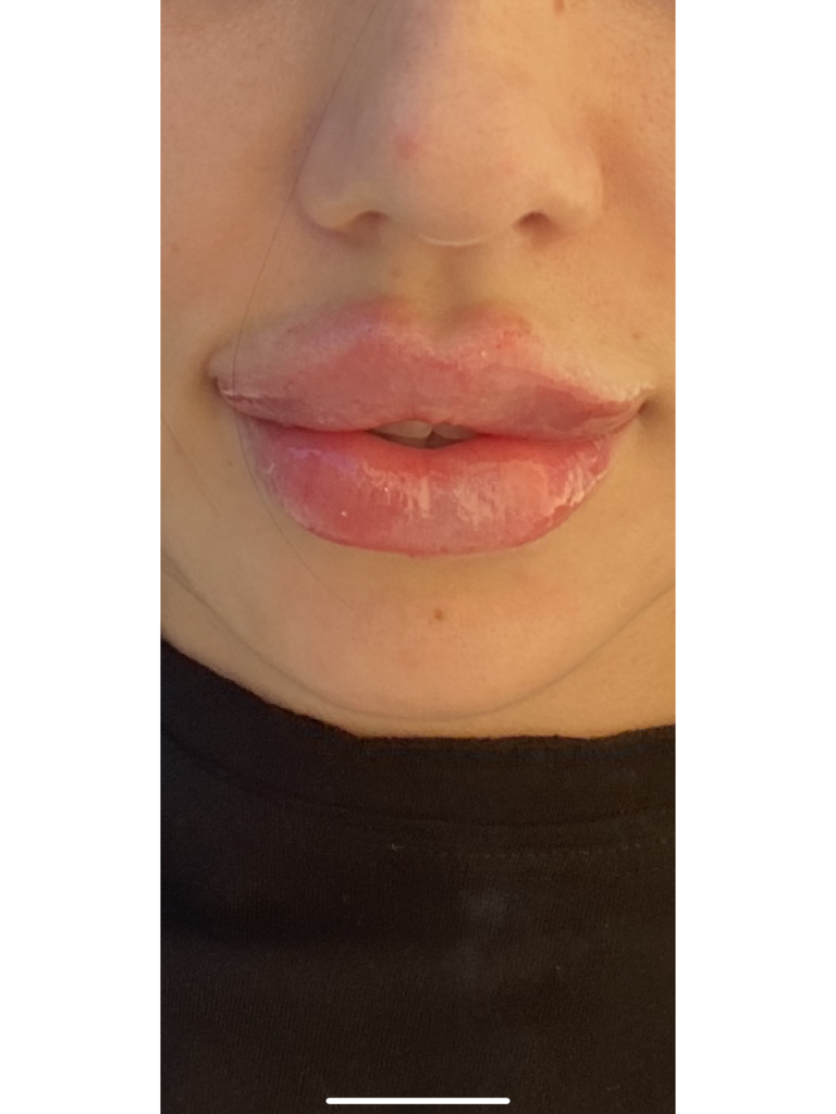 Фото 1. Как убрать валик над губой?