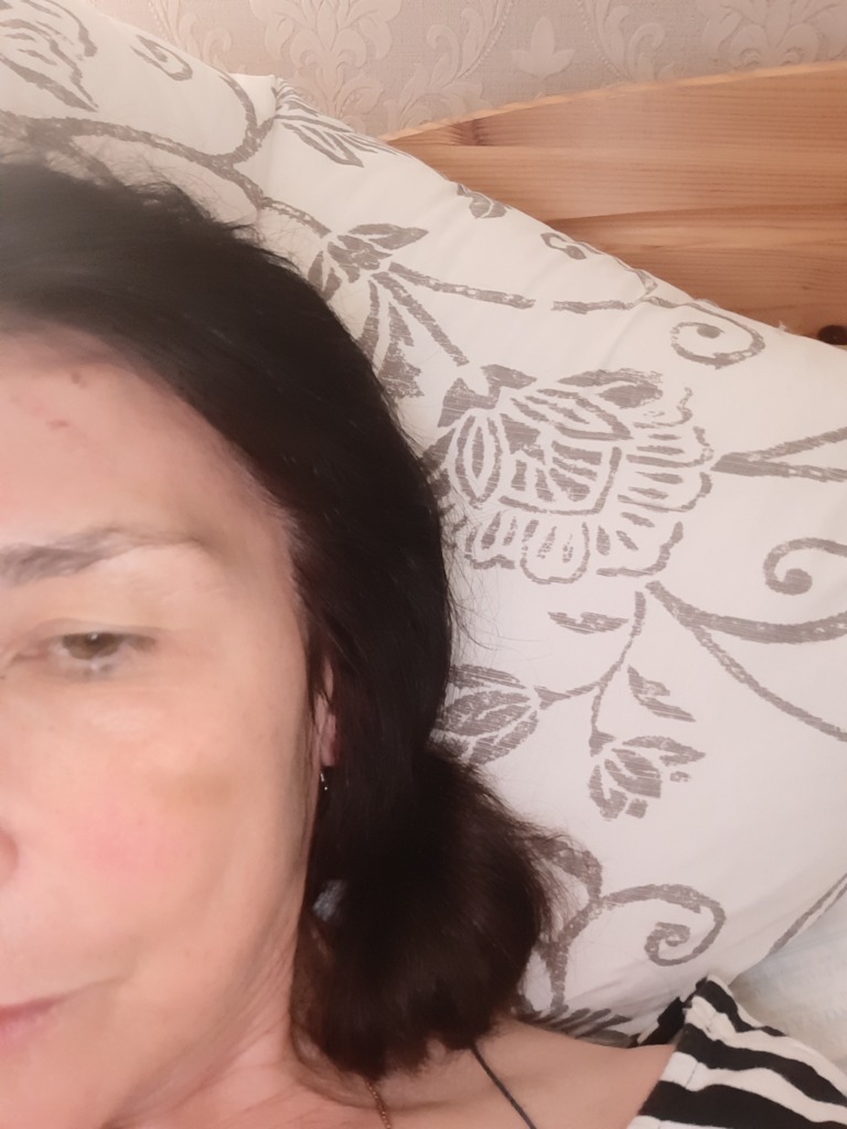 Фото 1. Почему могло возникнуть синее пятно после филлера?