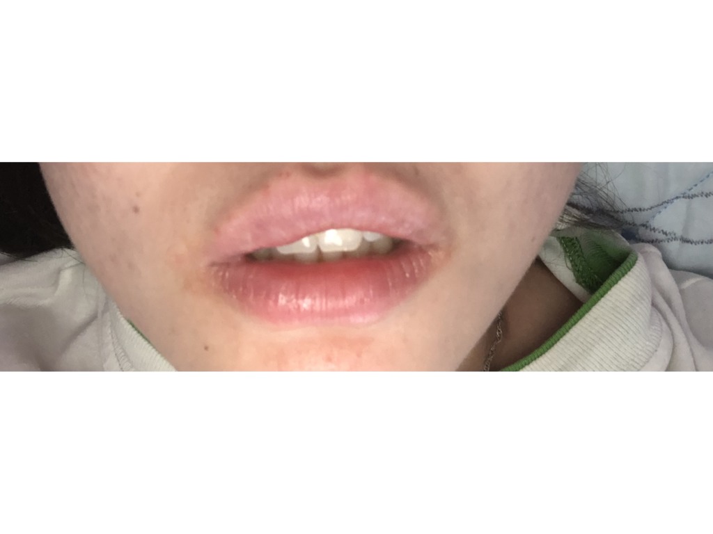 Фото 1. Как убрать шарик на верхней губе?