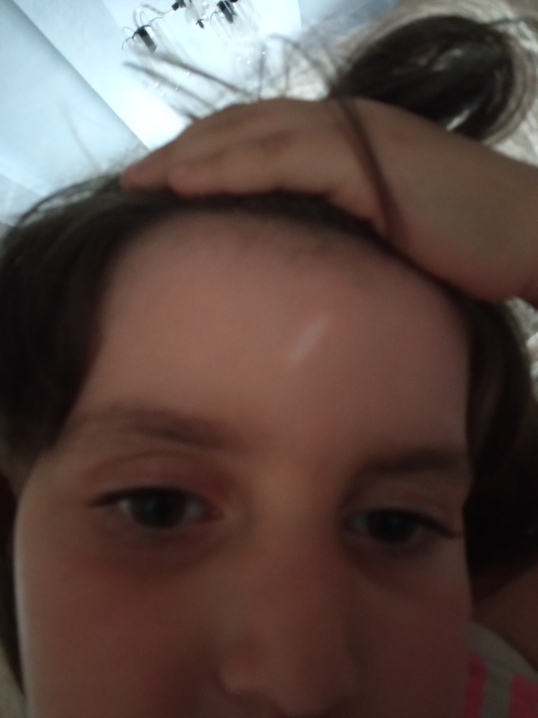 Фото 1. Можно ли делать лазерную шлифовку ребенку?