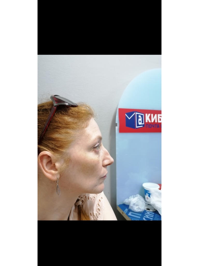 Фото 2. Можно ли убрать горбинку носа и избежать массивности?