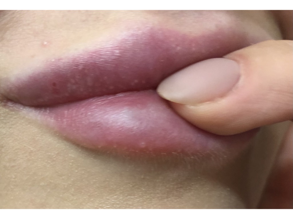 Фото 1. Что делать, образовываются непонятные шарики на губах?