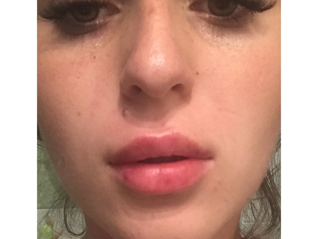 Фото 1. Выровняется ли неровность между губ?