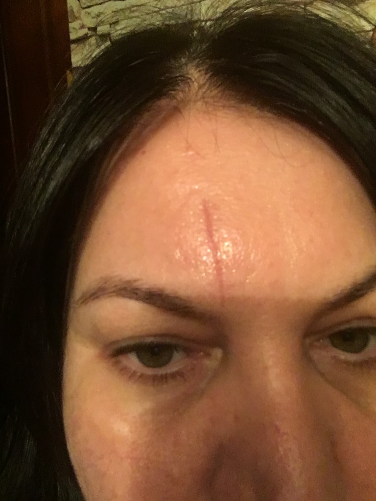 Фото 1. Что еще делать, чтобы минимизировать рубец