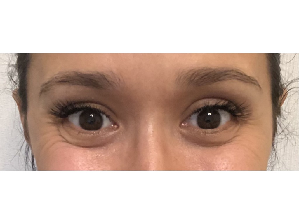 Фото 2. Поможет ли блефаропластика?