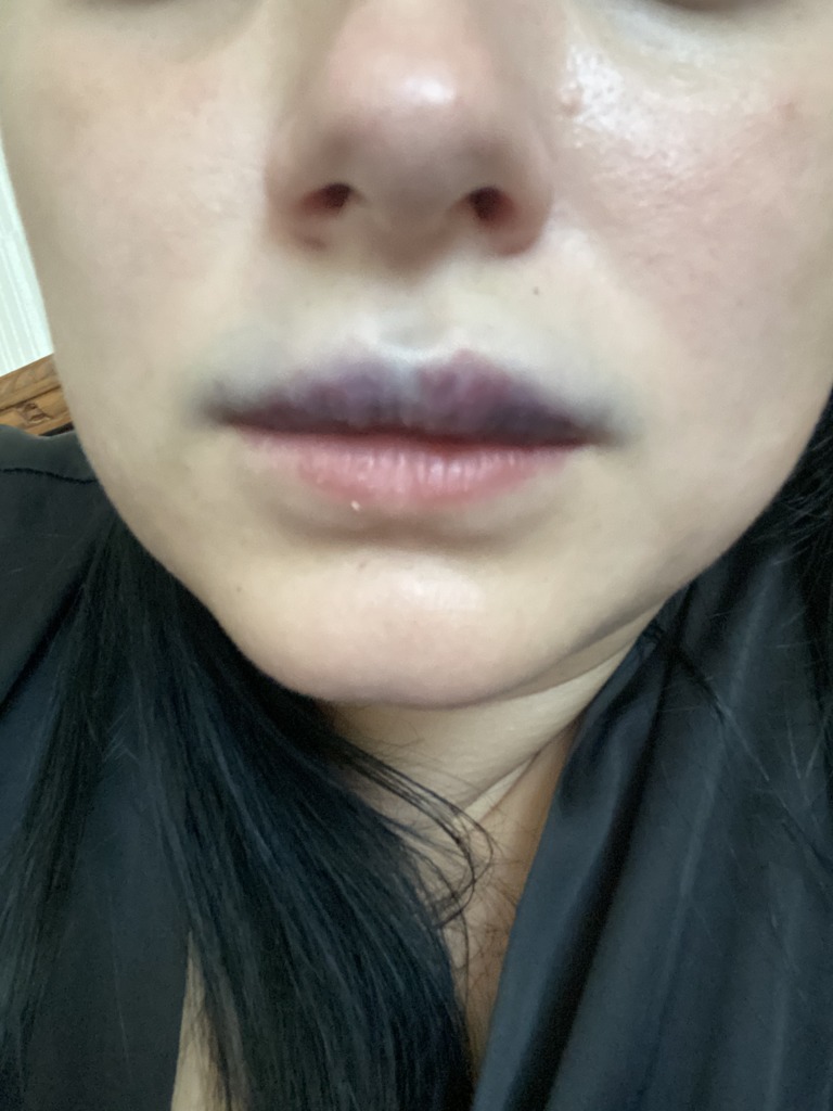 Фото 1. Подскажите, через сколько обычно такое проходит? 