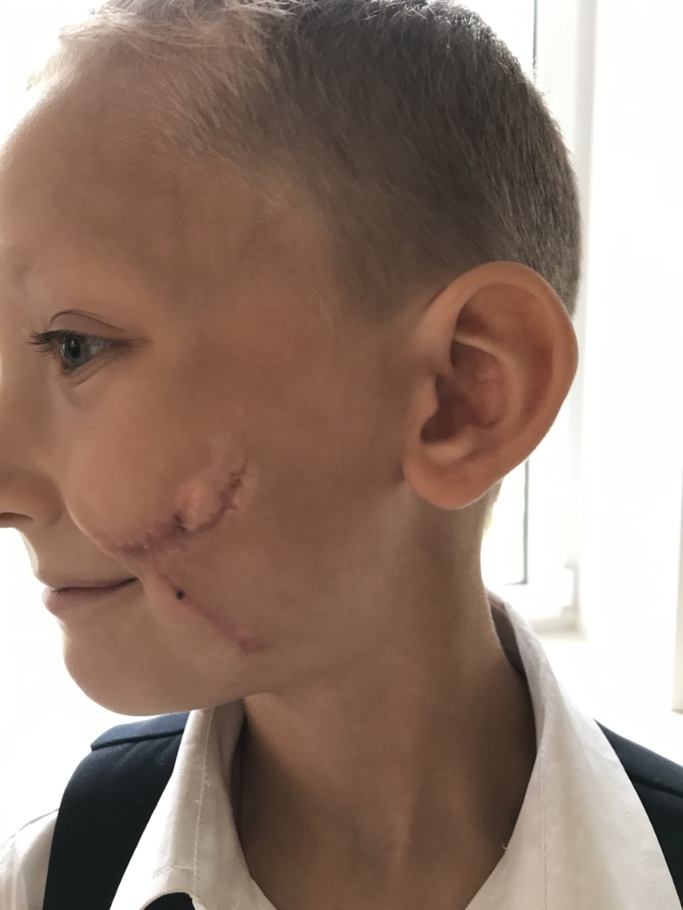Фото 2. Когда детям можно удалять шрам?