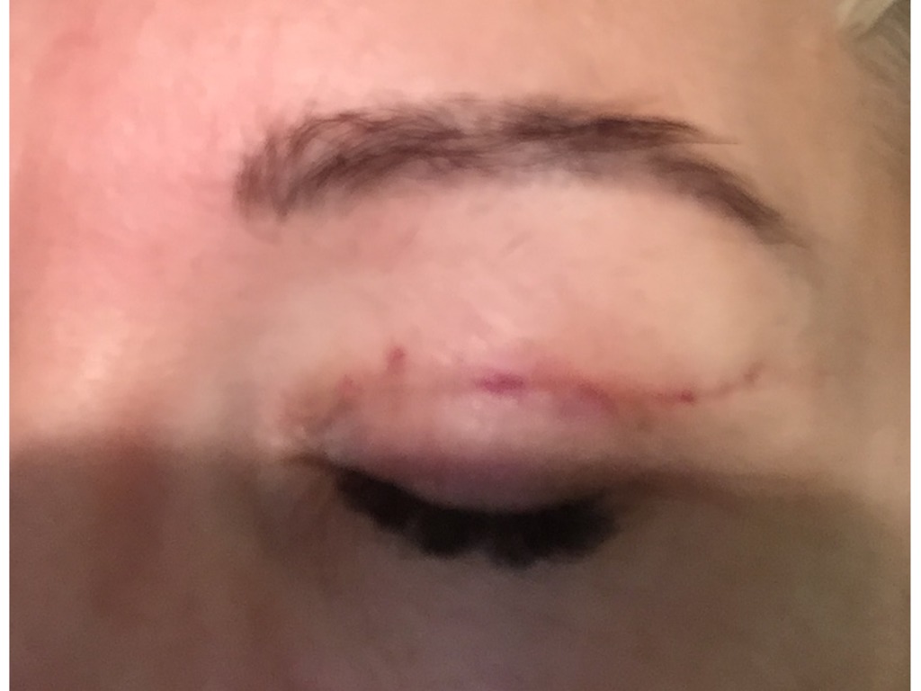 Фото 1. Останется ли рубец и что делать?