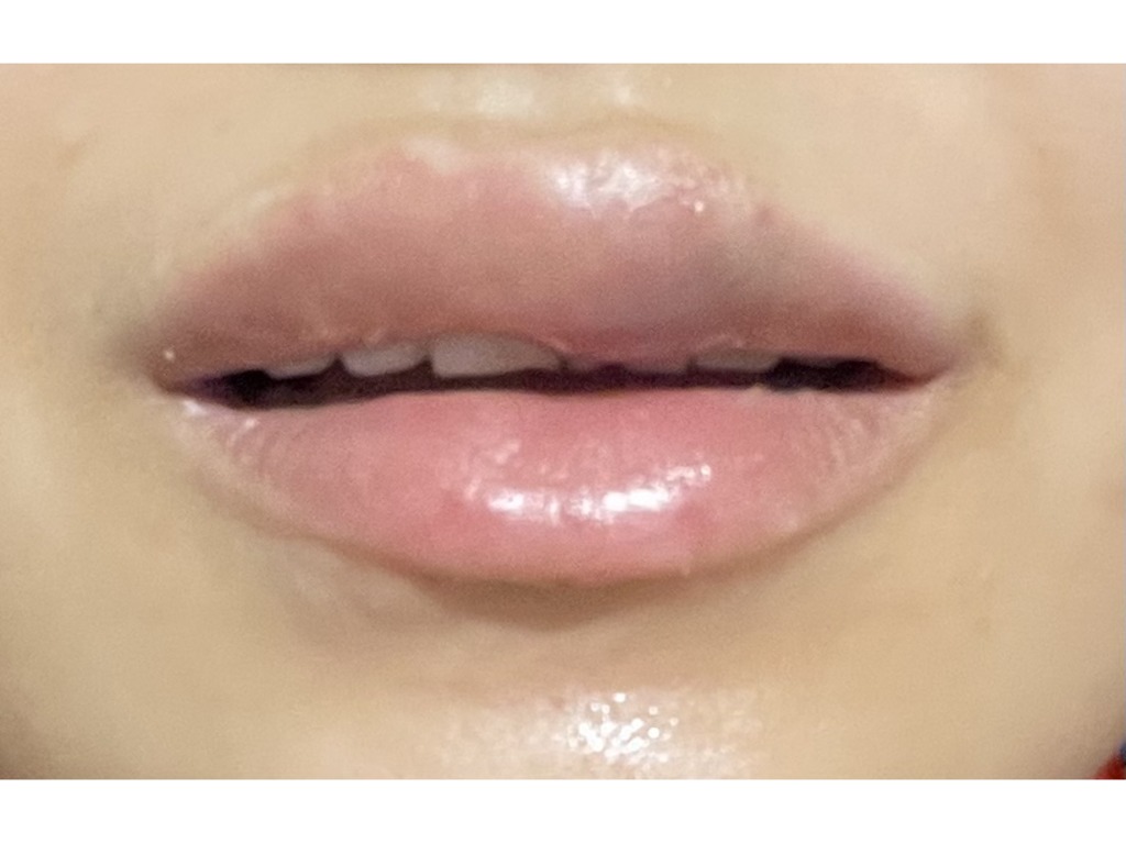 Фото 2. Гематома ли это и как скоро пройдет?