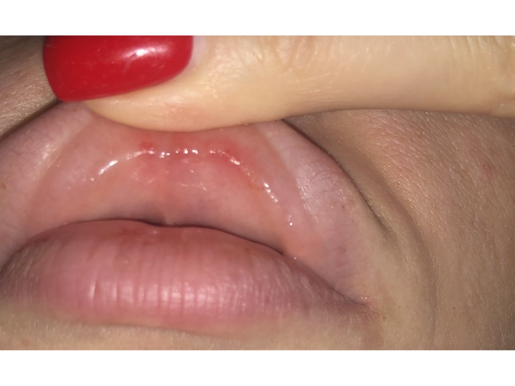 Фото 1. Почему образовываются ссадины и стоит ли из-за этого выводить филлер?