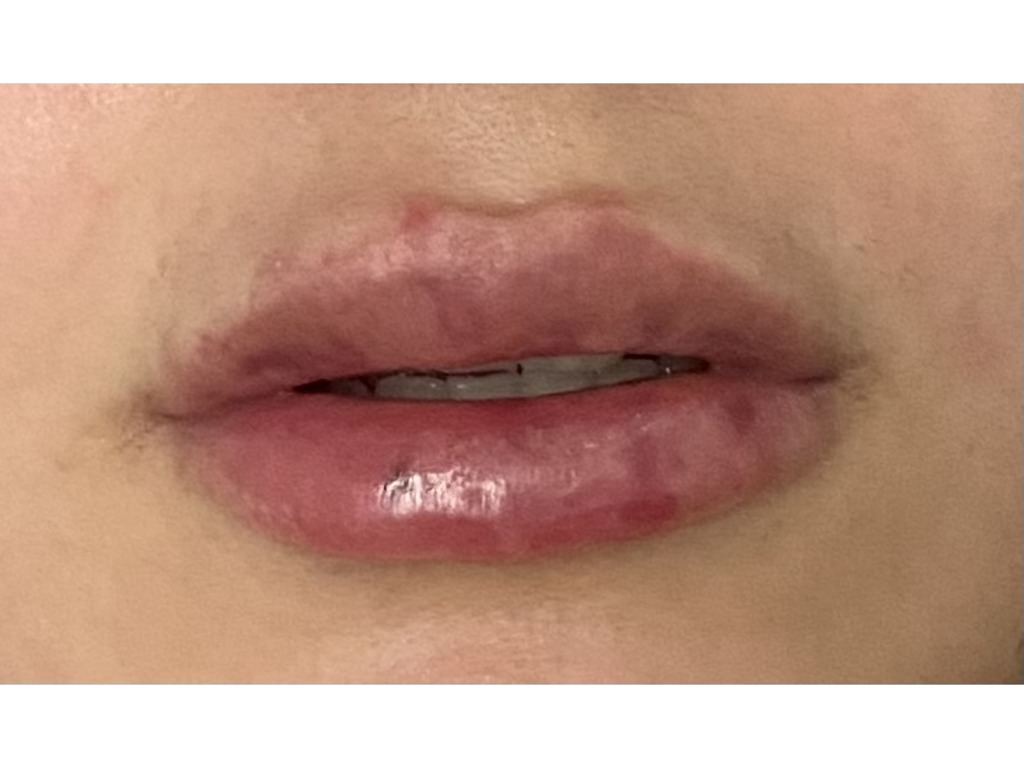 Фото 1. Когда пройдет отечность после процедуры?