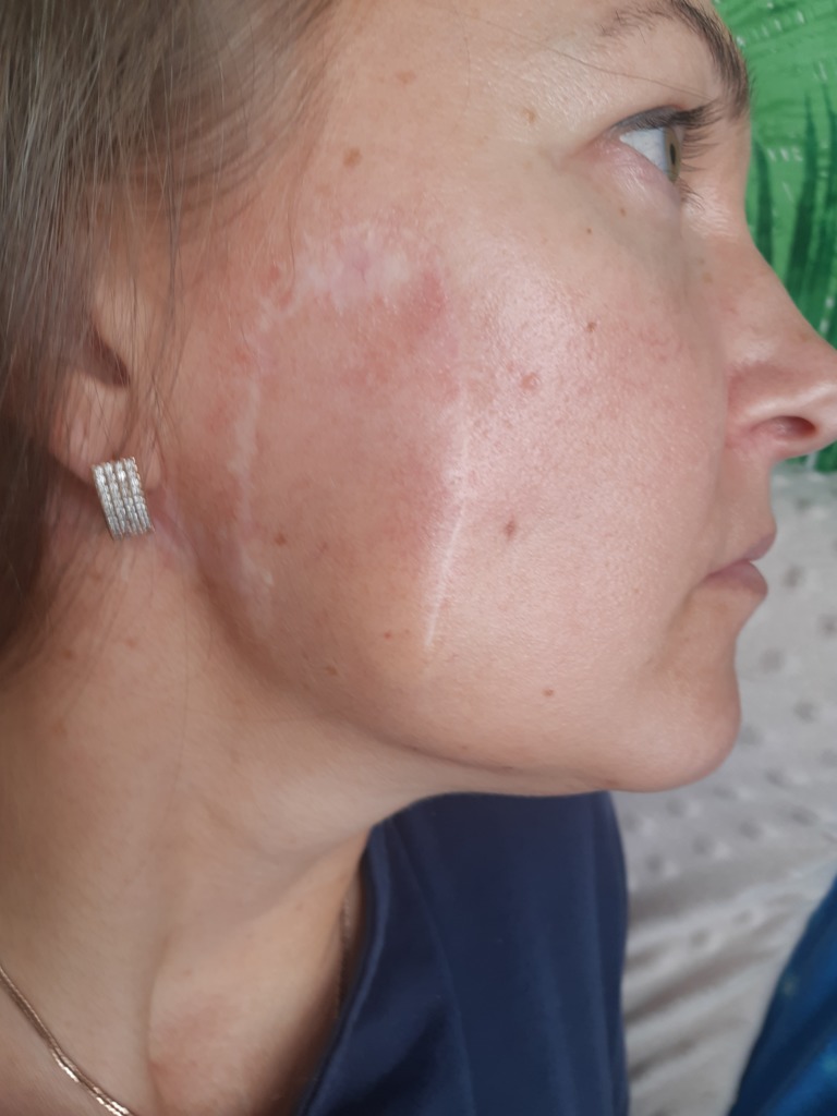 Фото 1. Как поправить овал лица, чтобы он стал симметричным?