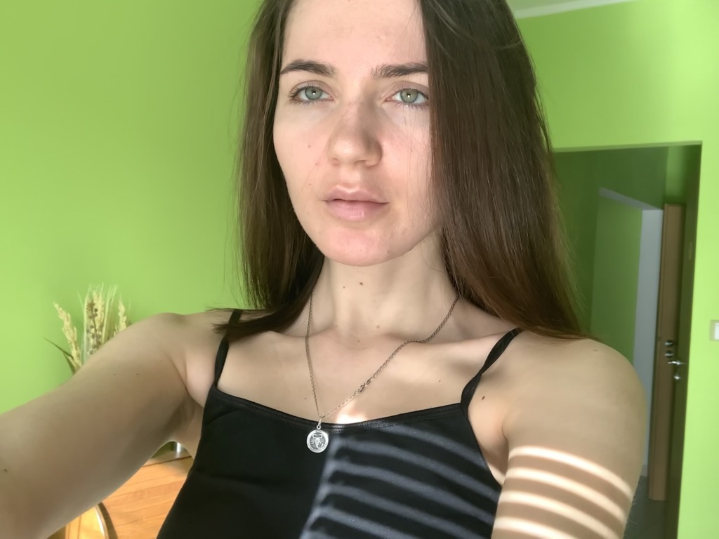 Фото 1. Можно ли исправить ситуацию массажем, или придётся удалять филлер Лидазой?