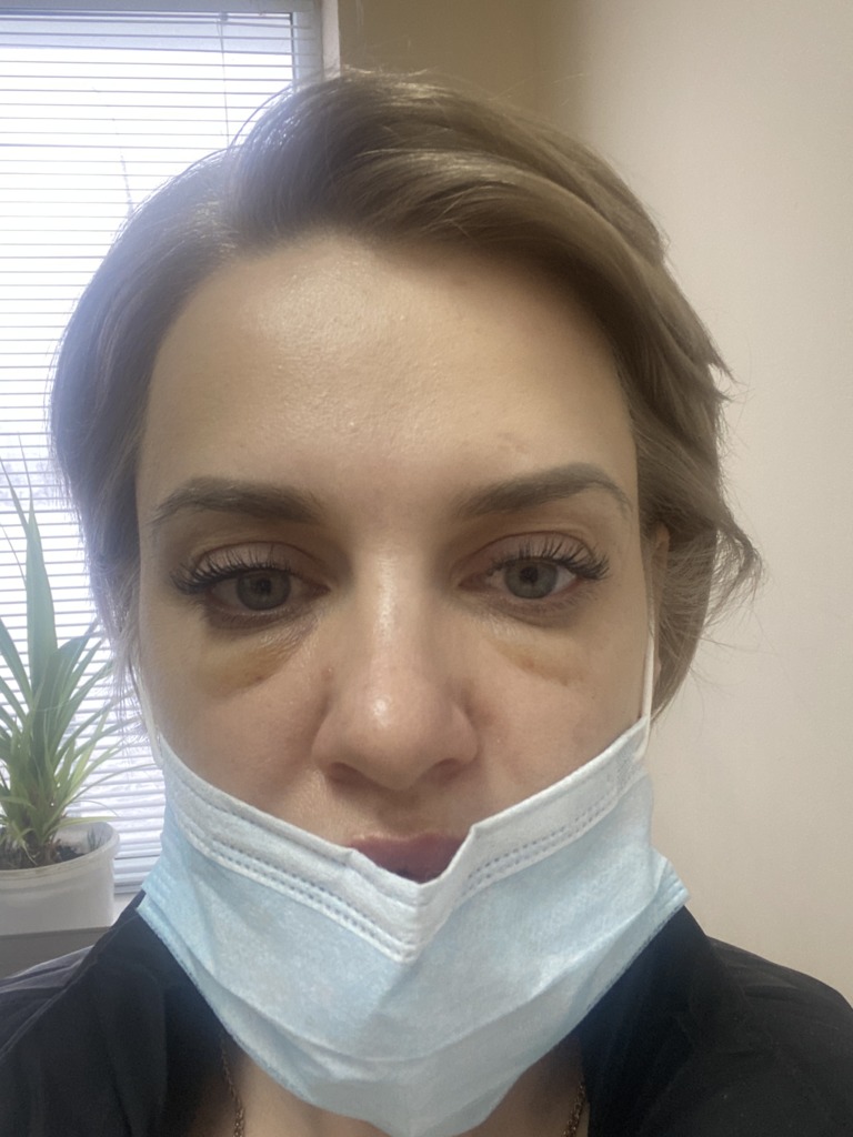 Фото 1. Нужно ли делать лимфодренаж, чтобы избавиться от отека после белотеро софт?