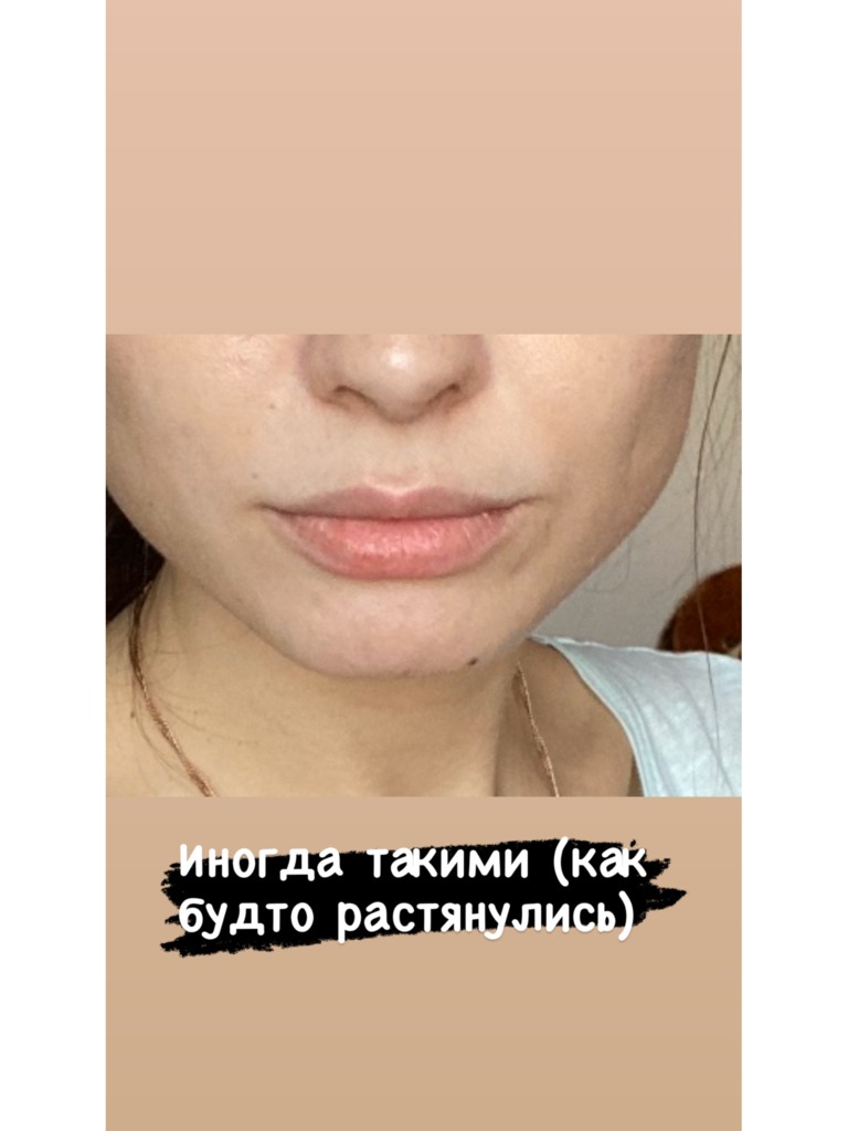 Фото 4. Что делать, если раздувает губы?