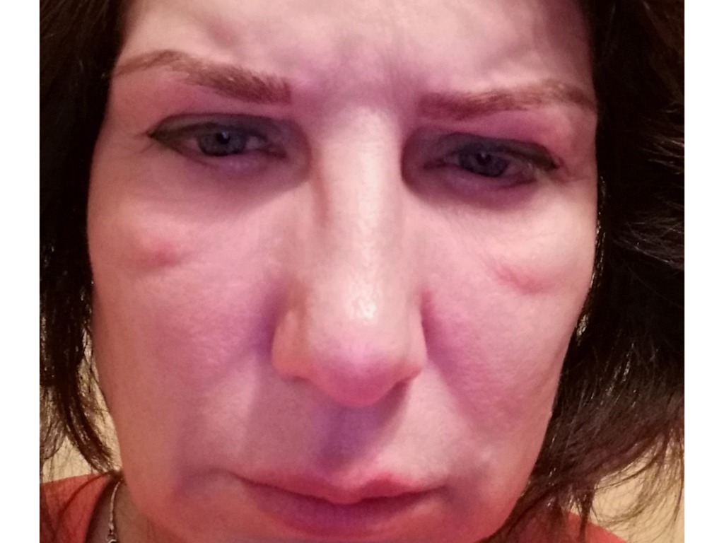 Фото 2. Как избавиться от мешков под глазами?