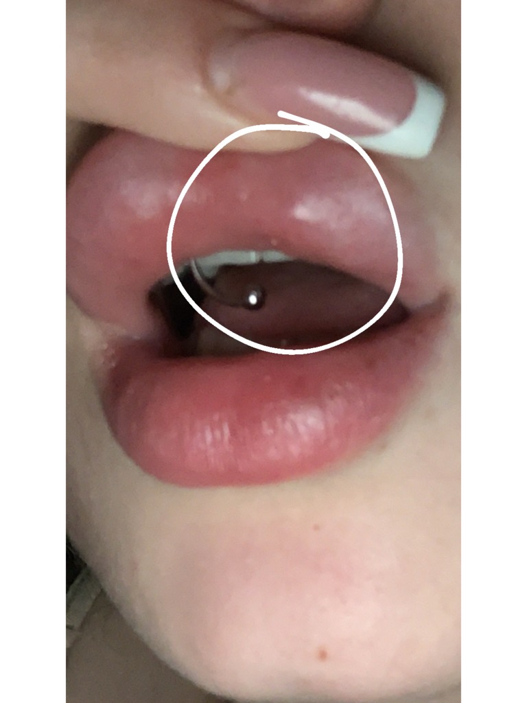 Фото 2. Может ли это быть миграция филлера?