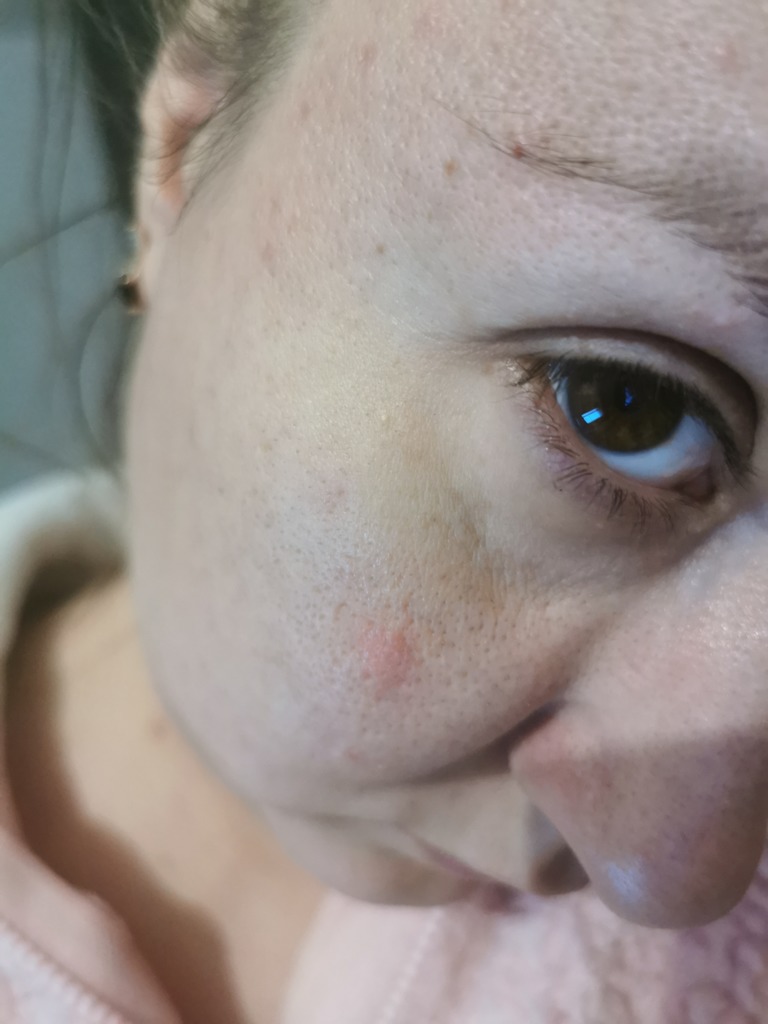 Фото 1. Как можно убрать образовавшуюся шишку после Ювидерм 3?