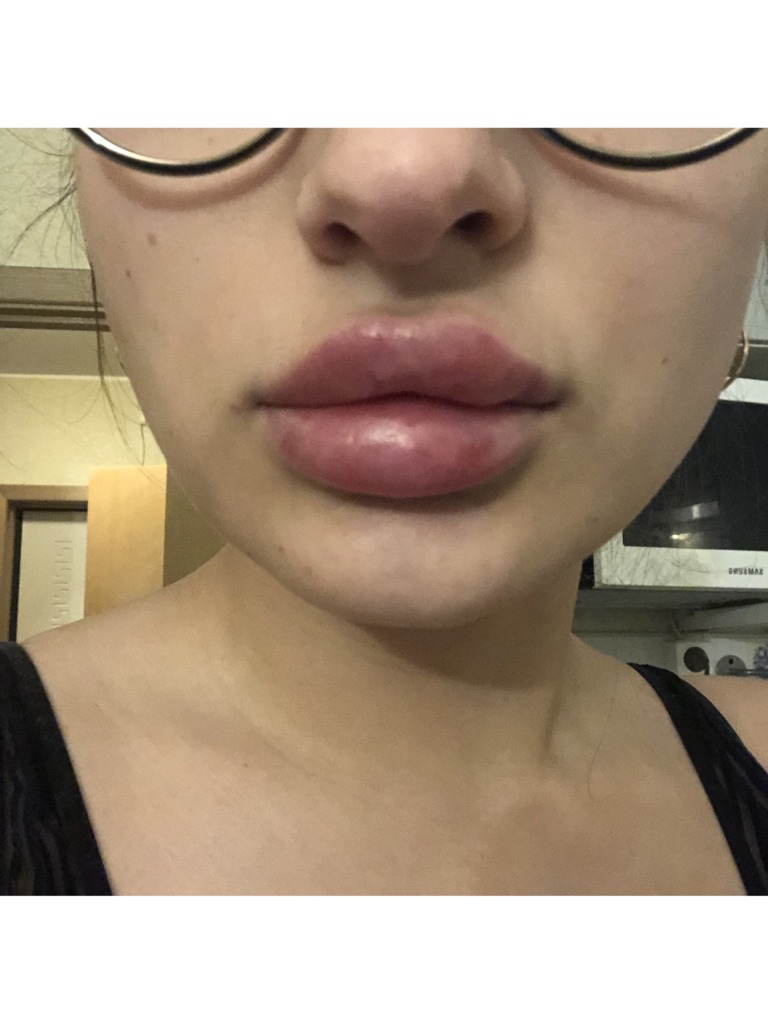 Фото 2. Почему отекают губы спустя несколько месяцев?