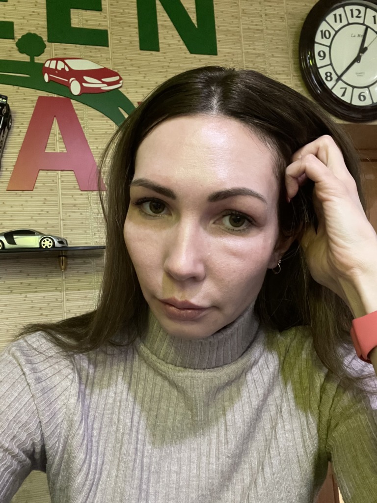 Фото 1. Как убрать отек от Профайло?