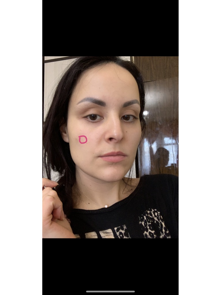 Фото 1. Можно ли утверждать что это скорей всего фиброз?