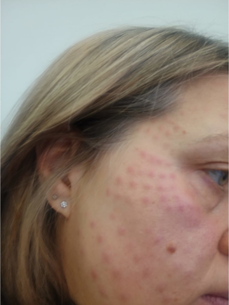 Фото 1. Как снять воспаление и появление папул от биоревитализации спустя неделю?