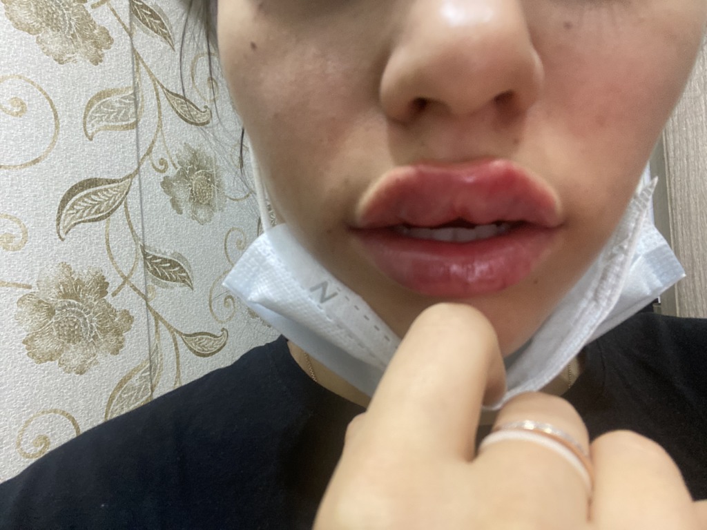 Фото 1. Уйдут ли комочки после увеличения губ?