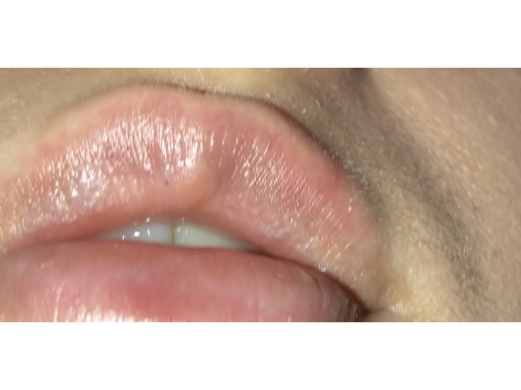 Фото 1. Почему появилась красная точка на губе?